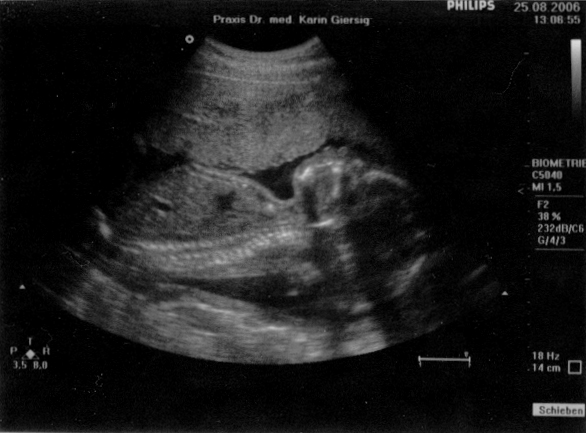 Ultraschall vom 25. August 2006 (1)