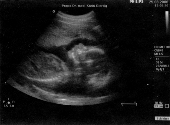 Ultraschall vom 25. August 2006 (2)