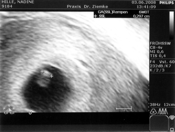 Ultraschall vom 03.06.2008