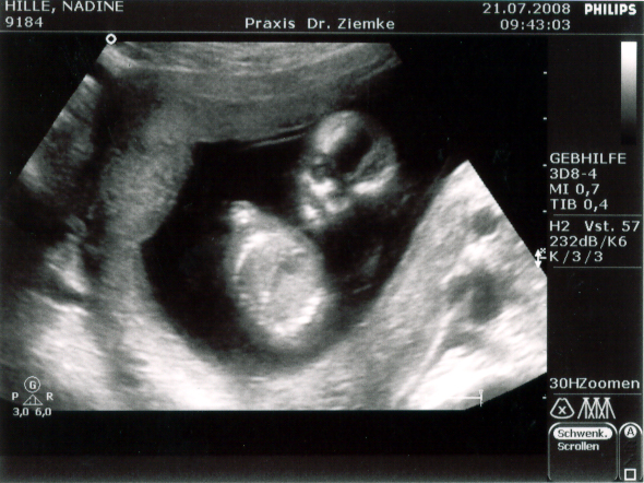 Ultraschall vom 21.07.2008