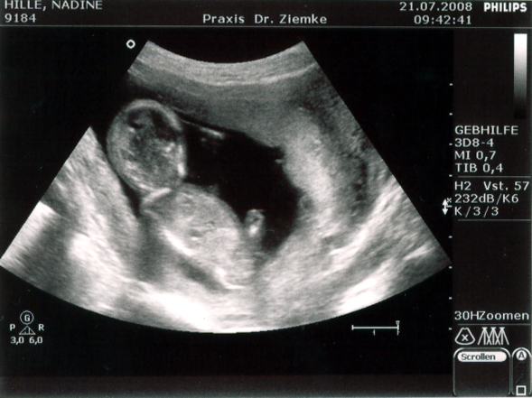 Ultraschall vom 21.07.2008