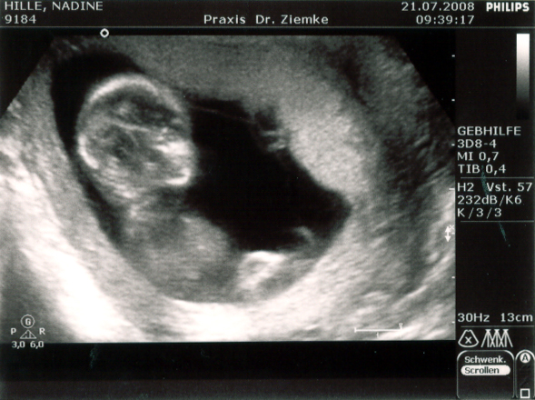 Ultraschall vom 21.07.2008